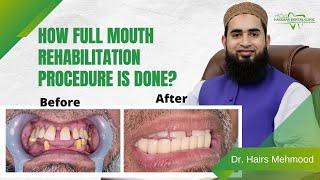 How Full Mouth Rehabilitation is Done? (2021)