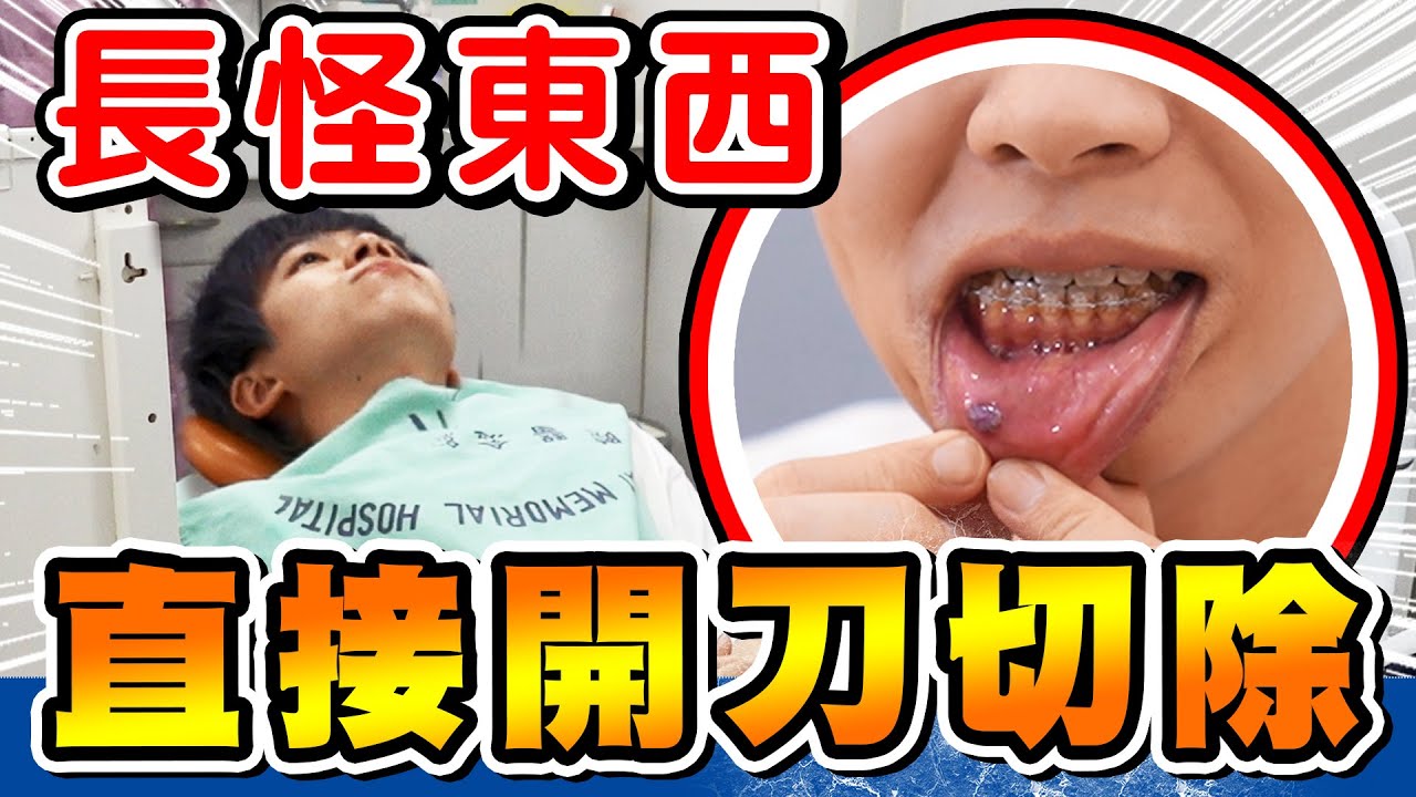 瑋瑋嘴巴長怪東西，直接到醫院動手術切除【黃氏兄弟】