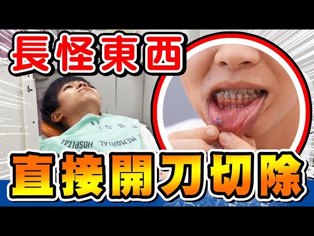 瑋瑋嘴巴長怪東西，直接到醫院動手術切除【黃氏兄弟】