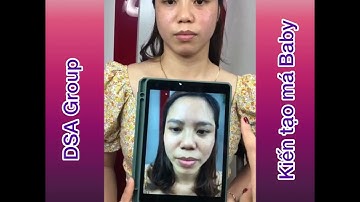 SIÊU PHẨM XOÁ RÃNH CƯỜI BẰNG TAY