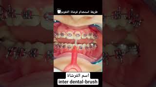 كيفية تفريش  الاسنان لحالات التقويم||How to brush teeth for cases of orthodontics