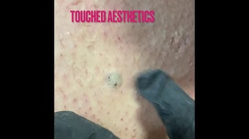 Episode 2 ingrown hair extractions