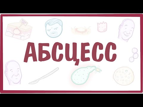 Видео: Абсцес на гърлото: симптоми, лечение, снимки, усложнения