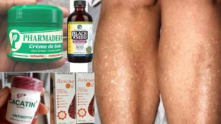 HOW TO CLEAR WHITE PATCHES &amp; WHITE DOTS ON YOUR SKIN with this PRODUCTS or HOME REMEDY