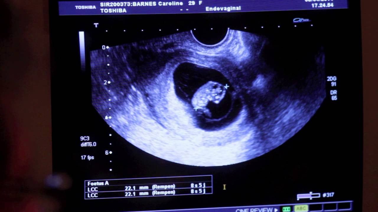 Caroline First Ultrasound 8 weeks / Primer Ultrasonido 8 semanas - YouTube