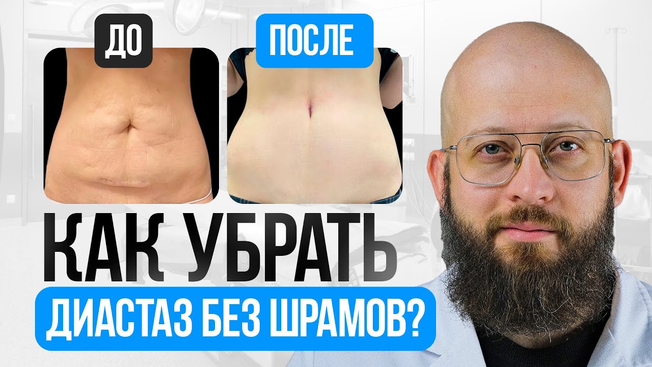 Про Метод Диастаза без Шрамов - YouTube