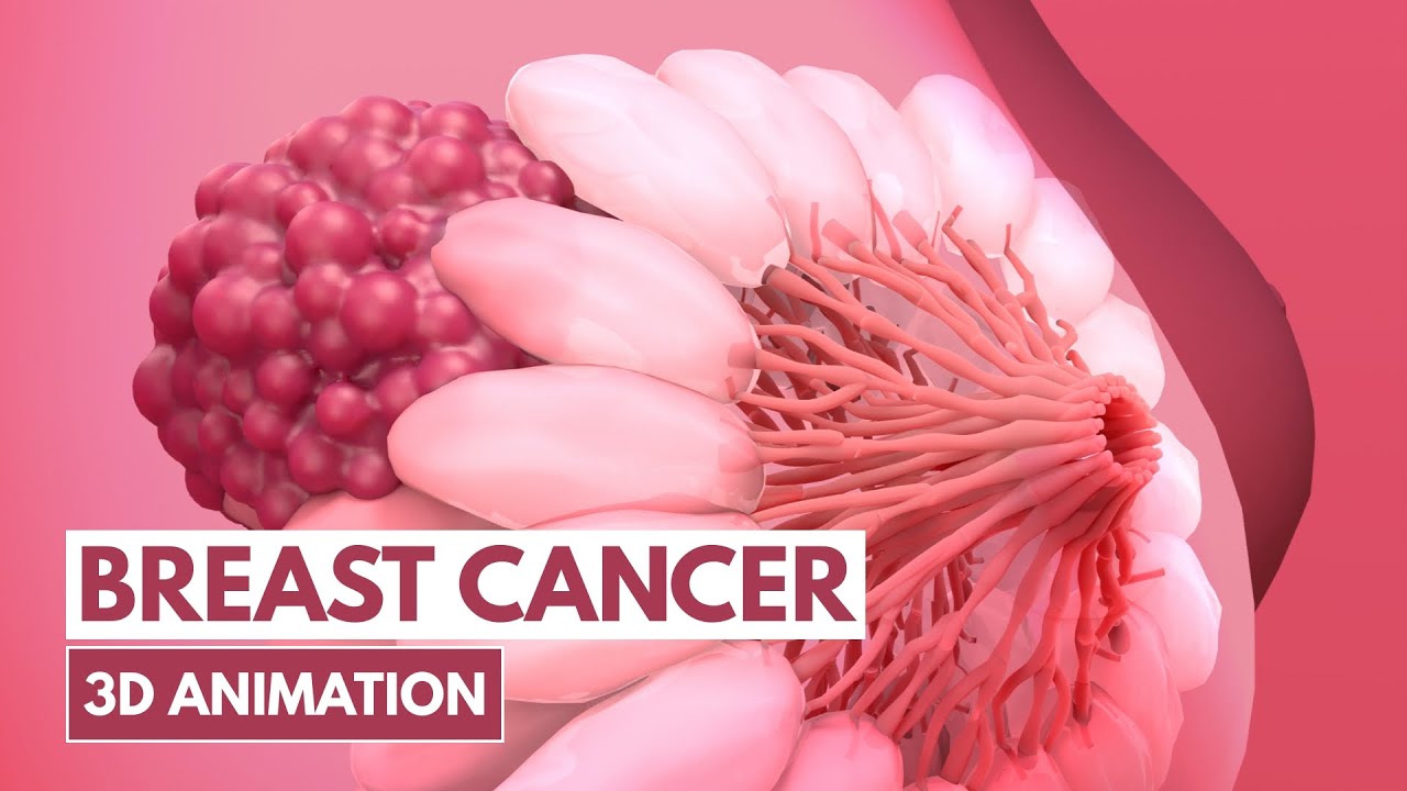 ⁣5 Signs of Breast cancer | 3D Animation