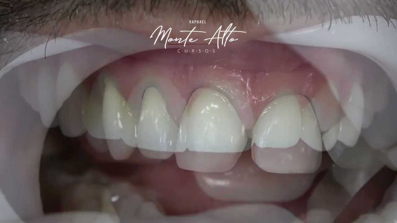 Cimentação Adesiva de laminados cerâmicos.