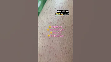 شعر تحت الجلد Shorts 