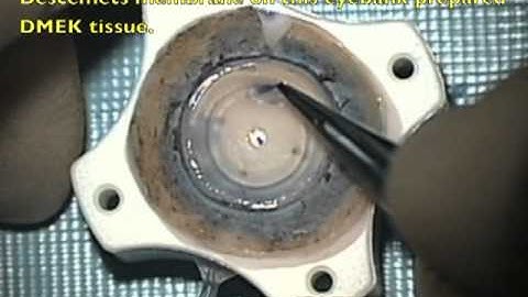 EyeBank prepared "pre-stripped" tissue for DMEK surgery