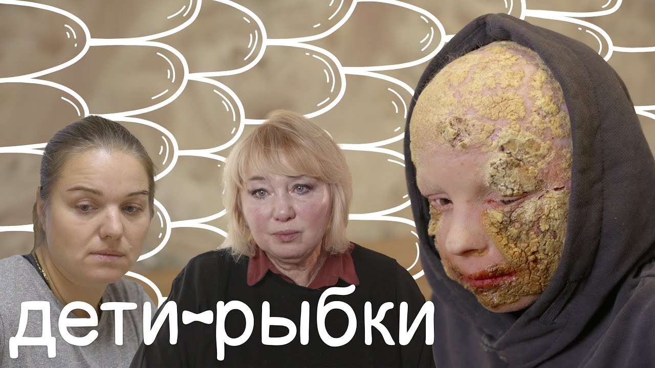 ИХТИОЗ и СИНДРОМ KID I История Кирилла Перчика