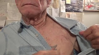 PACEMAKER - POSSIBLE FAILURE - REPLACEMENT SURGERY SOON  (OAG 2017)