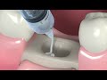 Frequently Asked Questions | Extraction and Bone Grafts