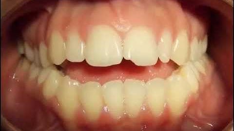 Class III with open bite by Dr Firas Albadran.wmv