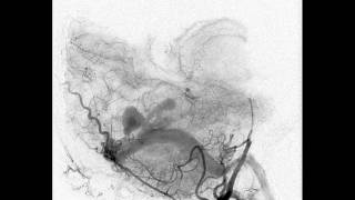 Patient information dural AVF vert lateral pre