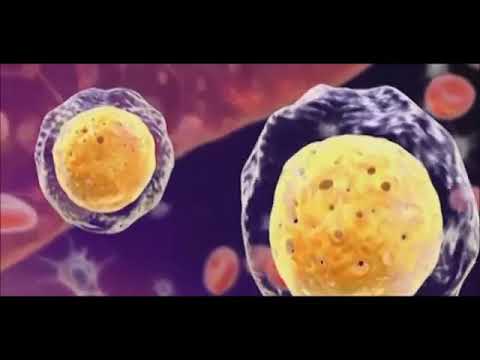Множественная миелома