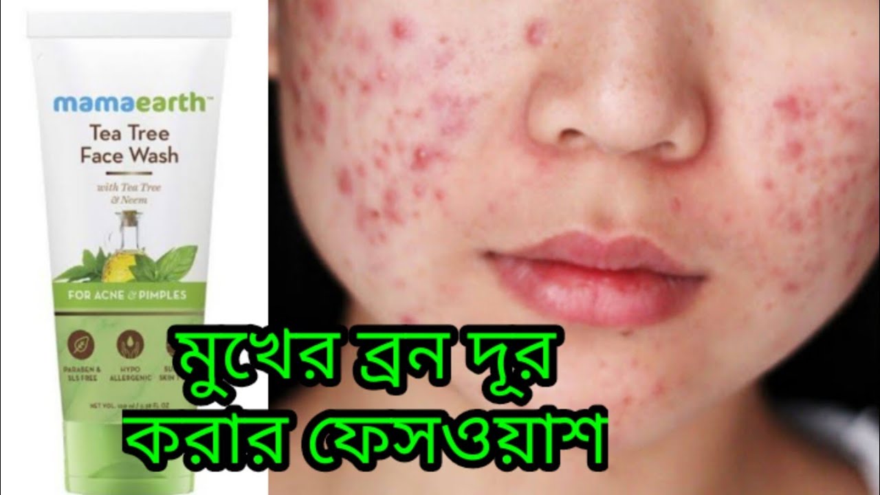 মুখের ব্রন দূর করার ফেসওয়াশ|mamaearth Tea Tree Facewash review|mamaearth|Facewash for Pimple Acne