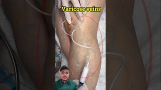 varicose vein ♥️ #varicoseveins #sclerotherapy #varicoseveinstreatment