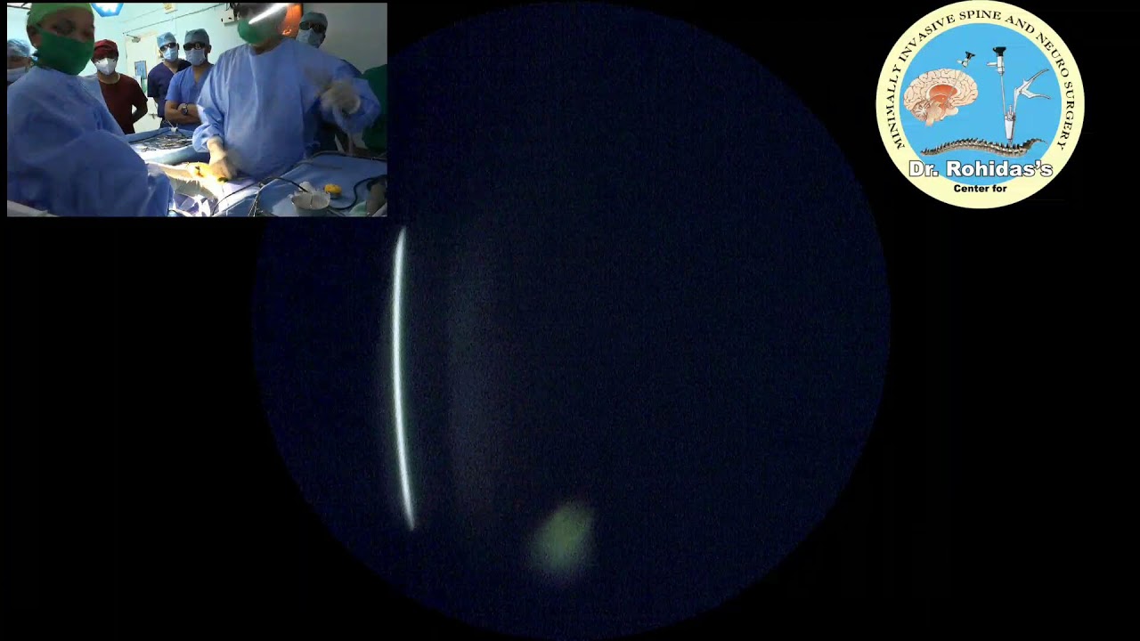 Lt. L5/S1, endoscopic discectomy YouTube