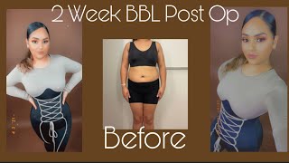 BBL 2 Week Post Op Update | Body Reveal | BBL, Arm and Chin Lipo | 305 plastic Surgery |