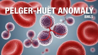 Pelger–Huët Anomaly (PHA) | Hematological Diseases | BMLS screenshot 2