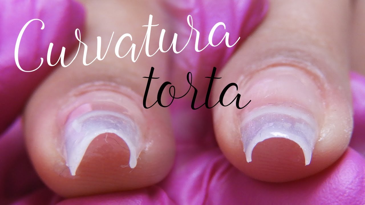 Curvatura Torta? Saiba O Que Fazer Para Isso Não Acontecer Curvatura Torta? Saiba O Que Fazer Para Isso Não Acontecer