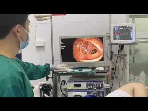 Nội soi can thiệp cắt polyp lớn đại tràng
