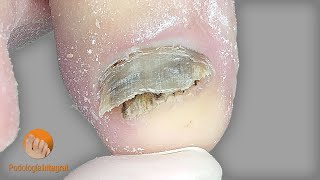 Fungal nails | Podología Integral