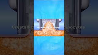 Metode Fat Freezing tercanggih dengan Cristal Pro #shorts