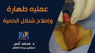 عمليه طهارة وإصلاح شنكل الخصية | دكتور محمد أنس