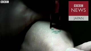脱北者の傷や入れ墨を除去　心の自由を