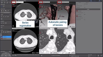 Myrian® XP-LungNodule