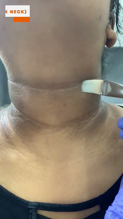 Acanthosis nigricans (black neck) at skinaa clinic | Viral #shorts