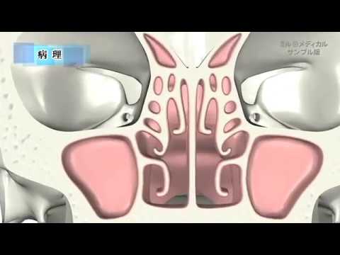 急性副鼻腔炎、慢性副鼻腔炎 ／2分で分かる医療動画辞典　ミルメディカル