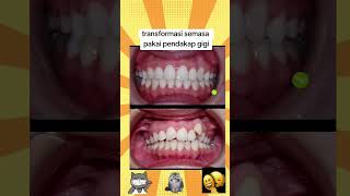 Siapa Pakai Pendakap Gigi Auto Nampak Cantik Senyuman Kan?.