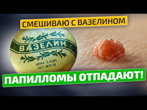 Папилломы, бородавки и другие образования на коже боятся этого средства!