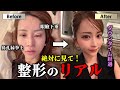 【私の秘密】美容整形のダウンタイムリアル経過を見せます。