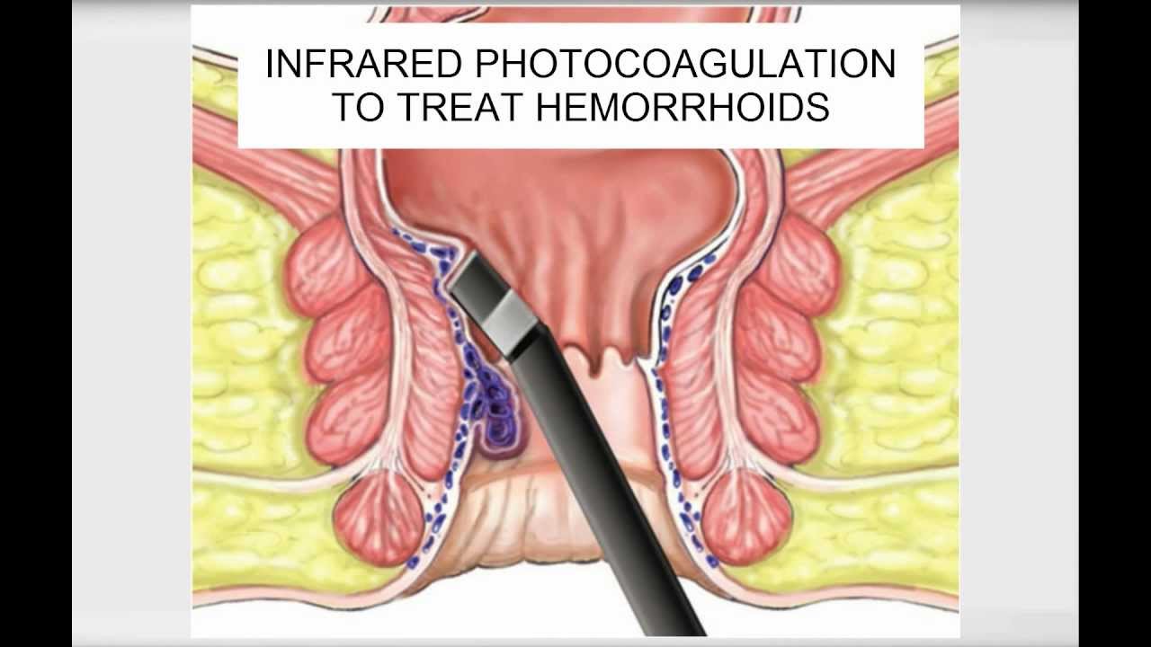The HELP Video Guide to Hemorrhoids - YouTube