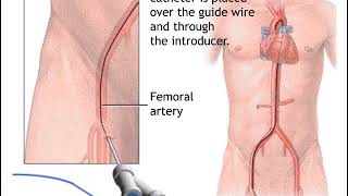How Atherectomy Surgery Works Animation - Directional Coronary Atherectomy - DCA Procedure Video