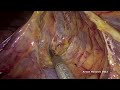 Lap beyond PME with hypogastric nerve resection and D3 lymph node dissection