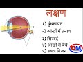 Astigmatism in hindi | astigmatism kya hota hai | Om Talk