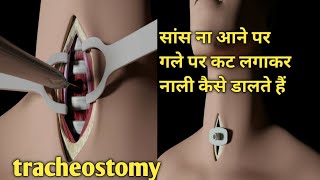 tracheostomy kaise nikalte hain / tracheostomy tube / gale me nali dalna  / gale ki piping kaise screenshot 5