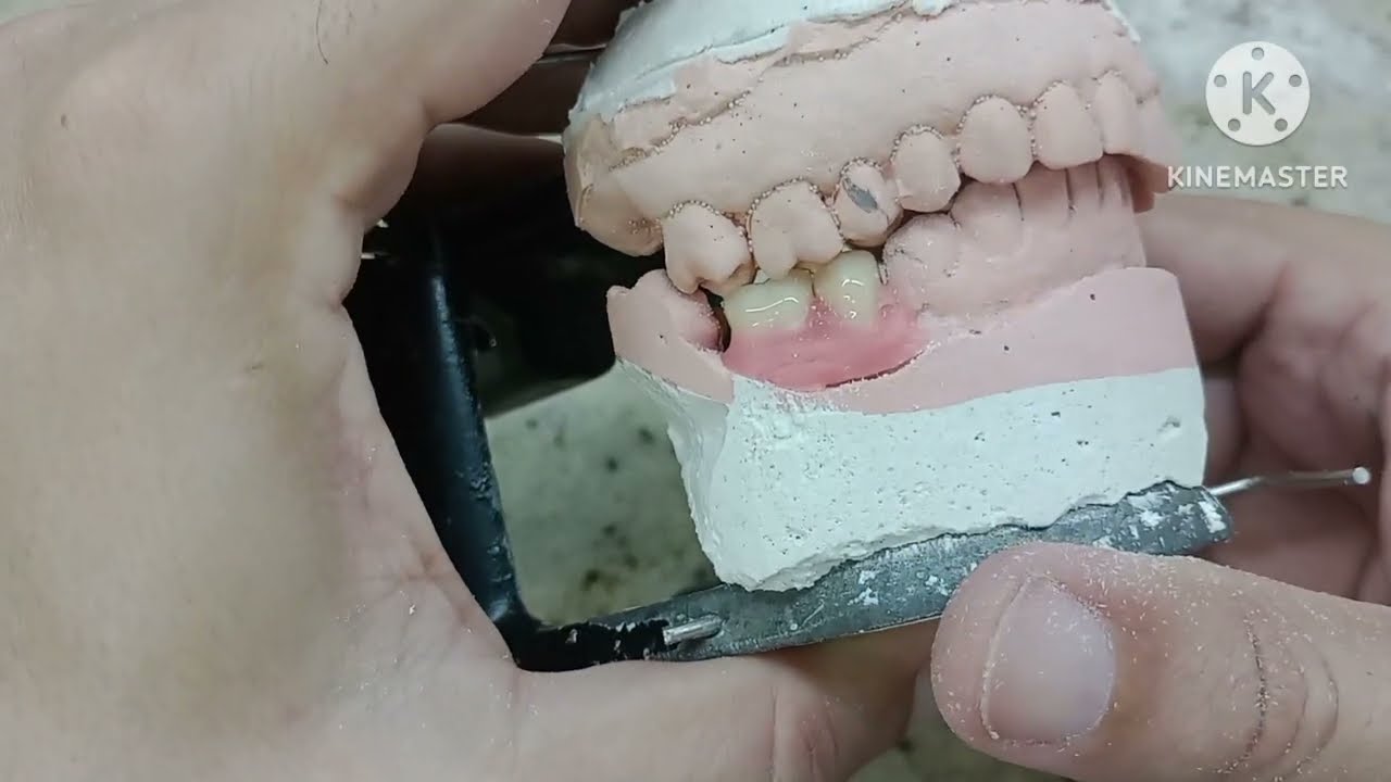 Dica de montagem e furação de dente para prótese flexível de alta qualidade.