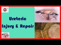 Ureteric injury and repair  end to end ureteric anastomosis