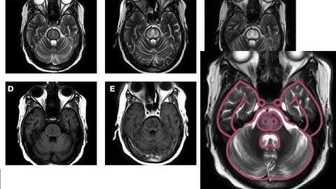 45. Osmotic demyelination syndrome; ODS, pontine myelinolysis, hyponatriemia correction, piglet sign