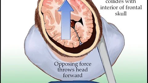 Mechanism of Axonal Shearing