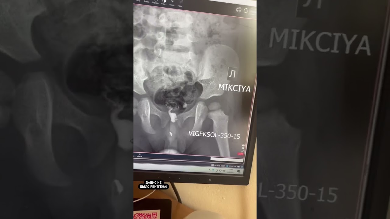 микционная цистография #рентген #рентгенолог #цистография