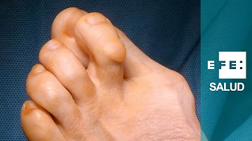 ¿Se puede llevar una vida normal sin un dedo gordo del pie?