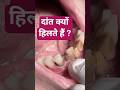 दांत क्यों हिलते हैं ?|| Loose teeth || #dentaltips