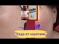 Сода и масло для удаления кератом и выравнивания кожи